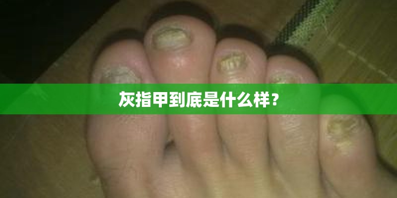 灰指甲到底是什么样？
