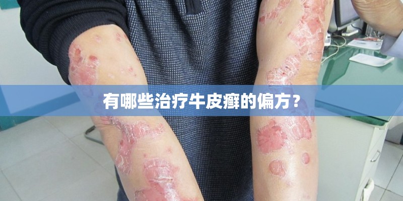 有哪些治疗牛皮癣的偏方？