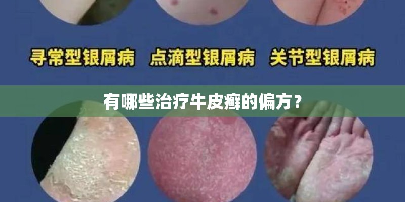有哪些治疗牛皮癣的偏方？