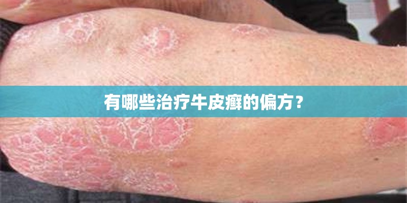 有哪些治疗牛皮癣的偏方？