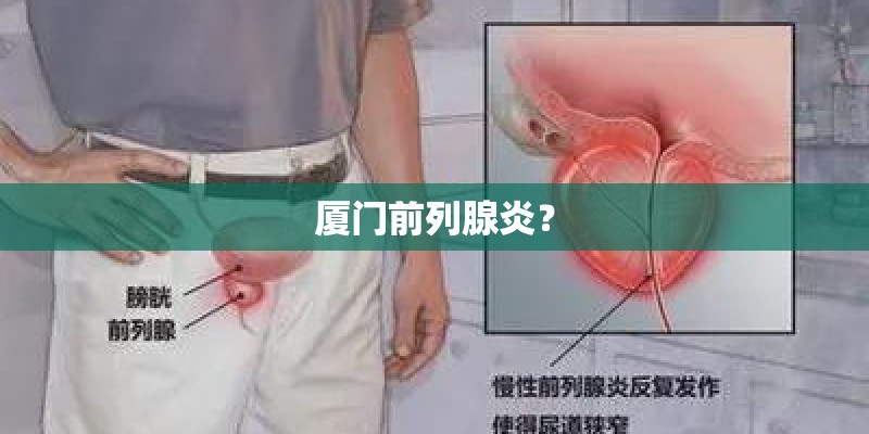 厦门前列腺炎？